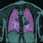 Towards 4D Object Modeling For Thoracic Insufficiency Syndrome